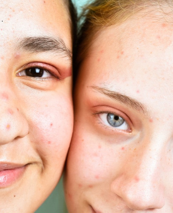 The Role of Diet in Acne: What to Eat (and Avoid)