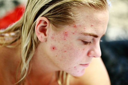 How Stress Affects Acne and Simple Ways to Manage It