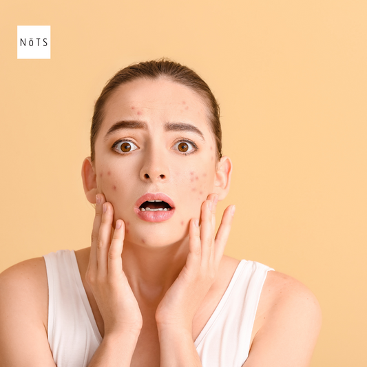 Should You Use Face Masks for Acne? Here Is What You Should Know.