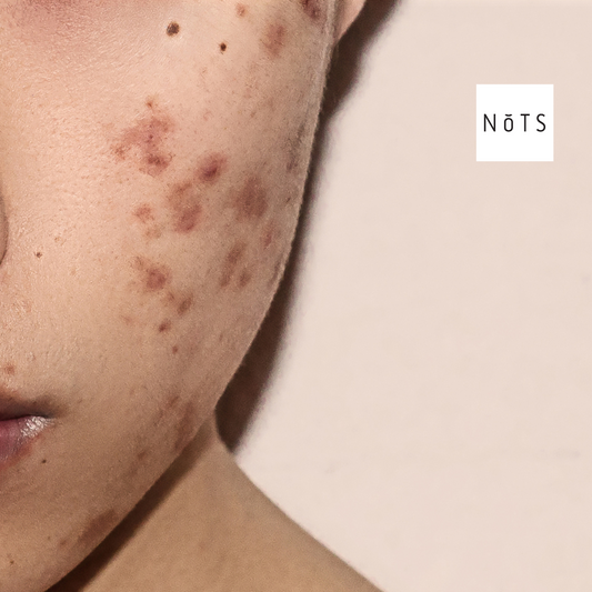 Discover the Best Scar Cream for Clear, Radiant Skin: NoTS Centellascar Ointment