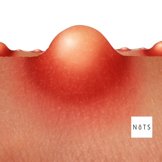 How to Prevent Acne Scars and Keep Skin Smooth.