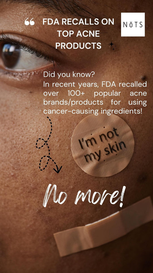 Safety Concerns with Acne Products: Hidden Dangers of Harmful Ingredients