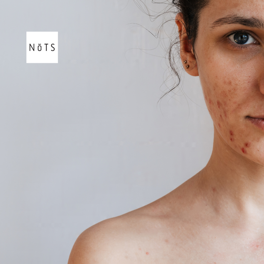 Why some acne scars never fade—and what to do about it.