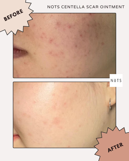 NoTS Centellascar Ointment -Best Scar Cream